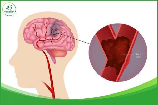 Hiện tượng thiếu máu não ảnh hưởng như nào đến sức khỏe của bạn?