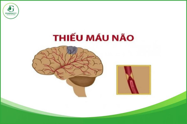 Bị thiếu máu lên não: triệu chứng và cách điêu trị