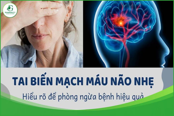 Triệu chứng tai biến mạch máu não nhẹ - Hiểu rõ để phòng bệnh hiệu quả