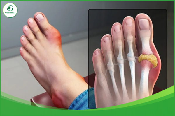 nguyên nhân gây đau nhức xương khớp