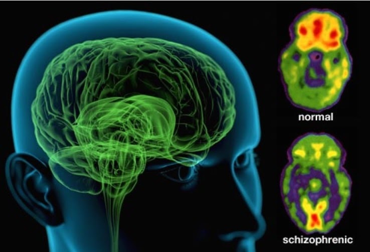 Tâm thần phân liệt có thực sự là một bệnh về não?