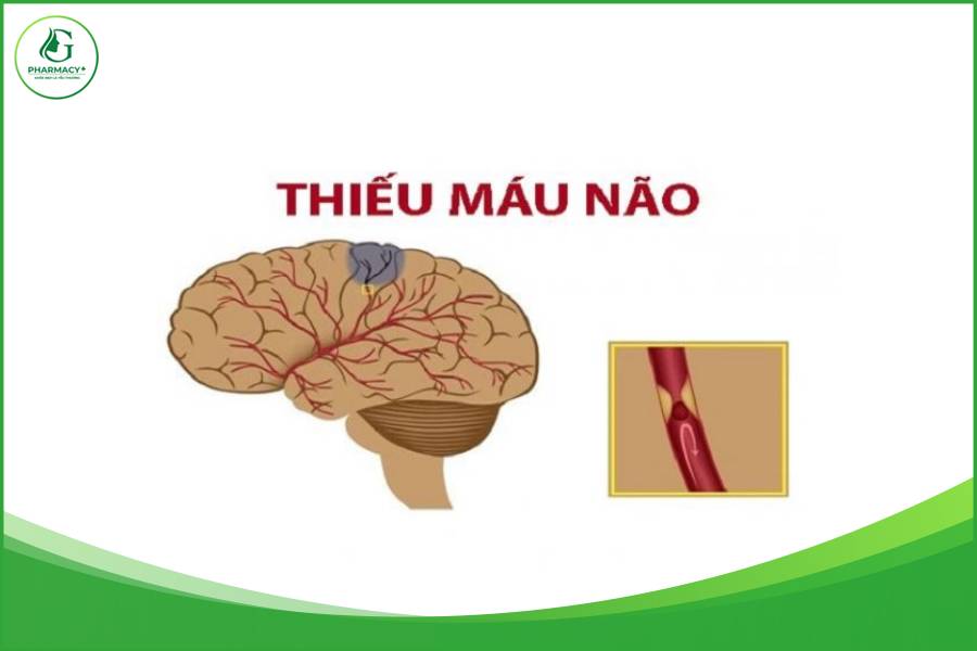 Bị thiếu máu lên não: triệu chứng và cách điêu trị