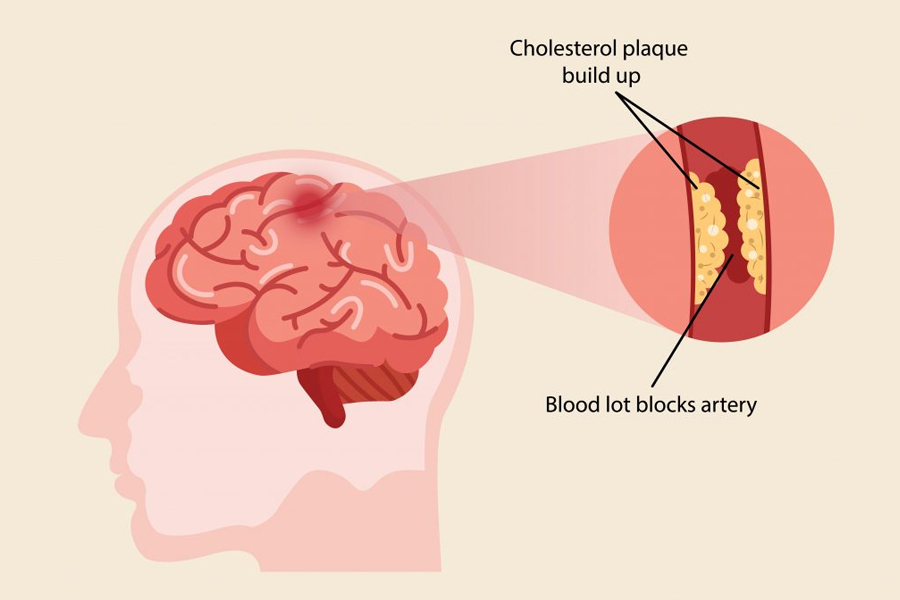 Tắc mạch máu não là gì? Tắc mạch máu não có nguy hiểm không?